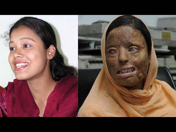 அழகிய முகத்தில் ஆசிட் வீச்சு