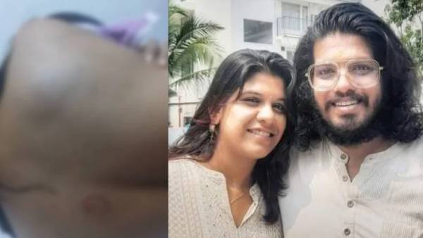 கடித்த தழும்புகள் காயங்கள்